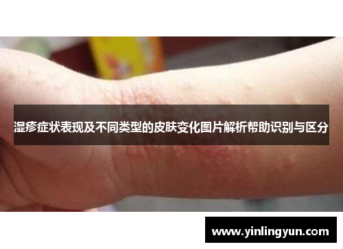 湿疹症状表现及不同类型的皮肤变化图片解析帮助识别与区分